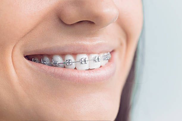Best Teeth Whitening  in Saks, AL